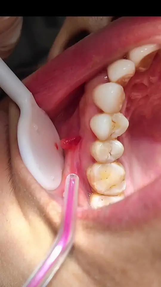 长瘘管提示牙根下面有炎症噢