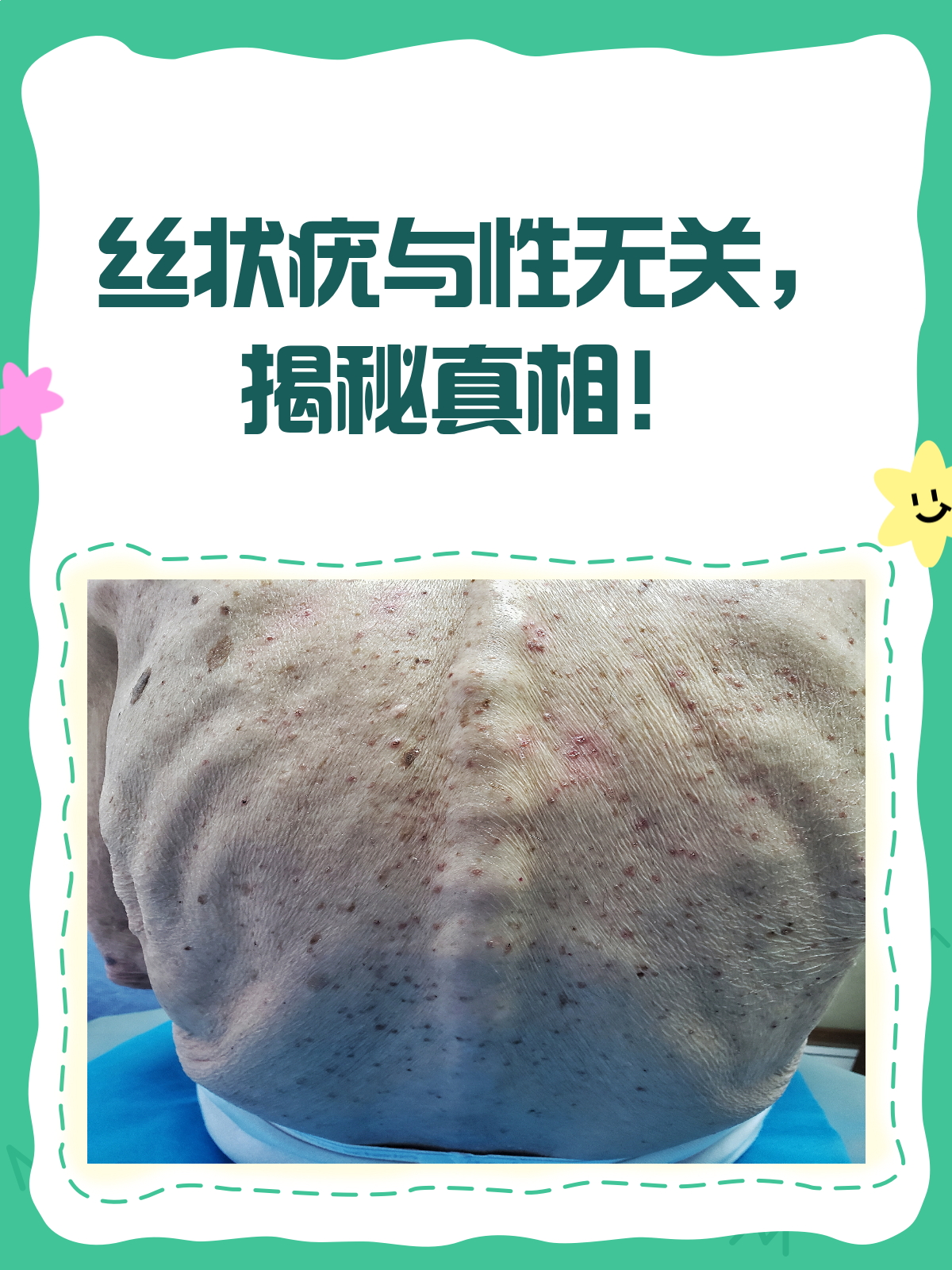 为什么会长丝状疣