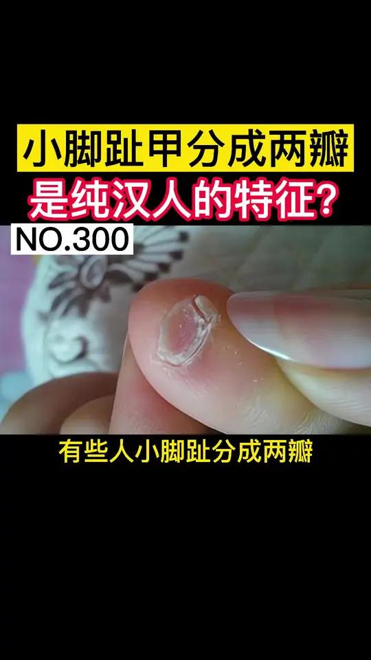 听听皮肤科教授怎么说的,你们身边有人小脚趾也是这样的吗?评论里聊聊