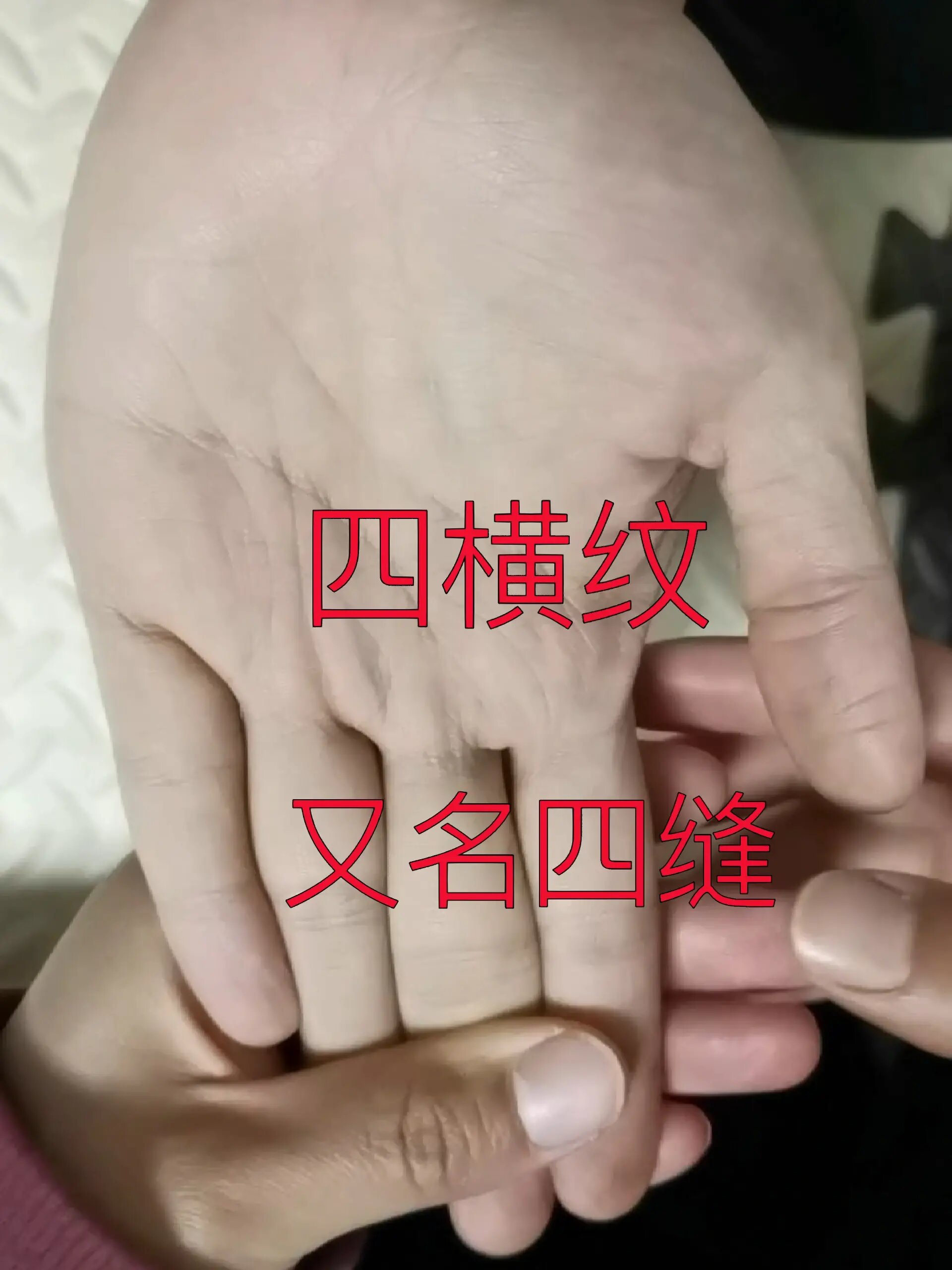 每日一穴——小儿推拿——四横纹