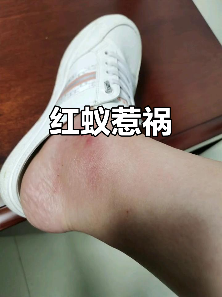 怀孕8月,红蚂蚁咬伤让我脚肿得无法站立,疼痛难忍