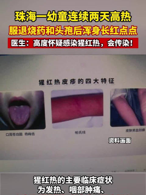 家长怀疑是药物过敏,于是到医院就诊,经专家诊