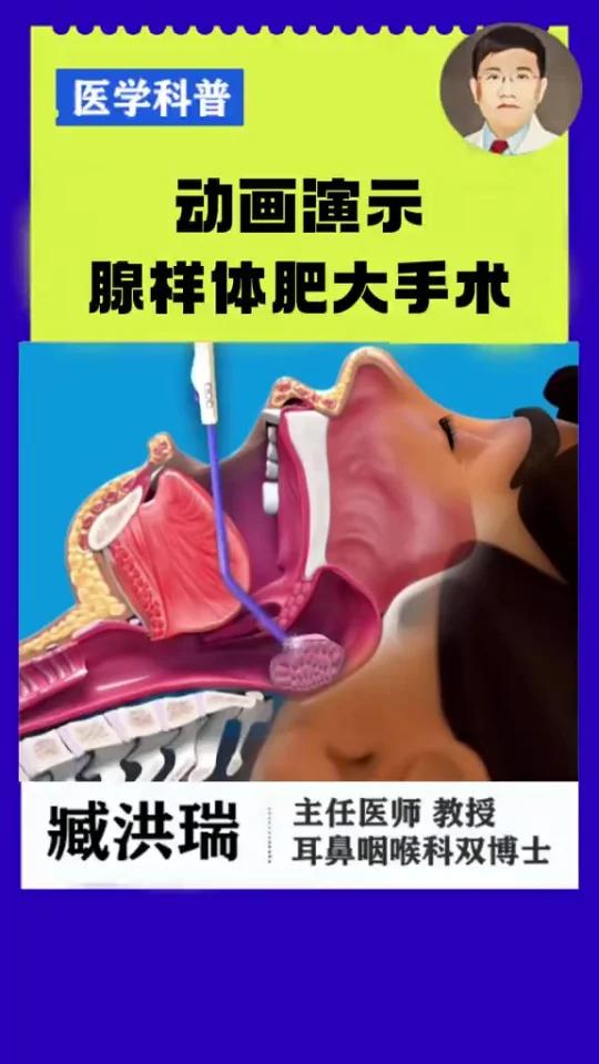 动画演示腺样体肥大手术