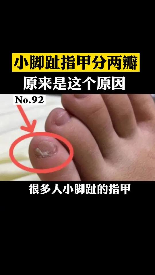 你的小脚趾趾甲是不是也是一大一小两瓣瓣状甲很常见,你知道是上面