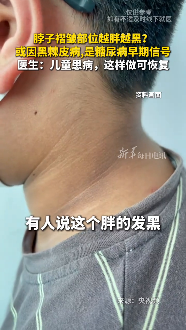 脖子褶皱部位越胖越黑?或因黑棘皮病,是糖尿病早期信号