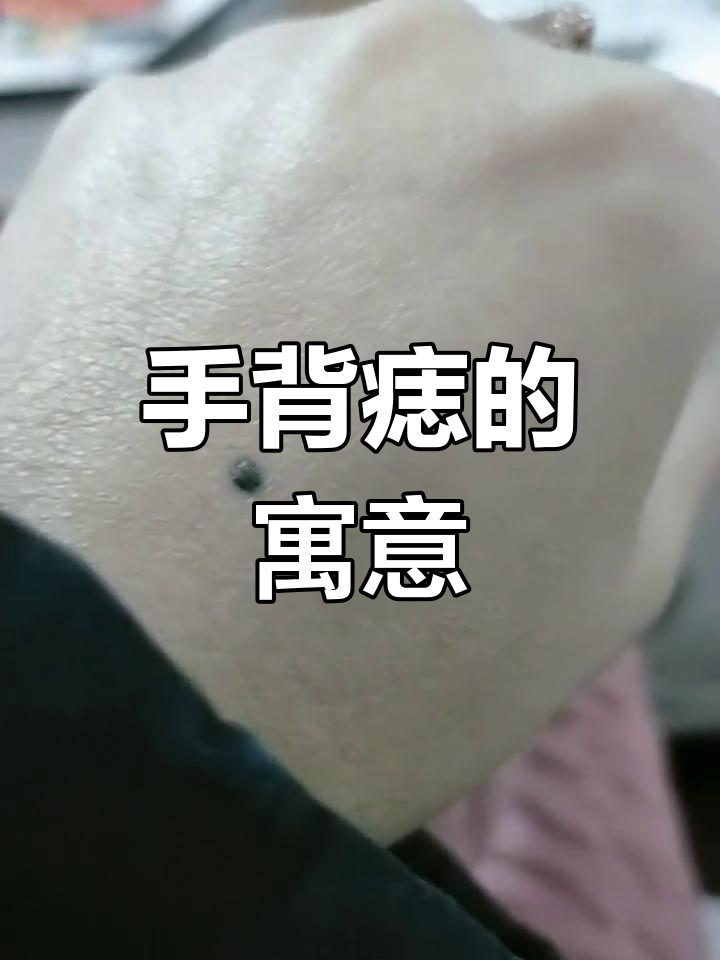 老人说,手背痣象征历经磨难后,未来将一帆风顺