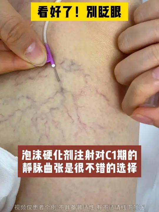 小腿毛细血管扩张图片