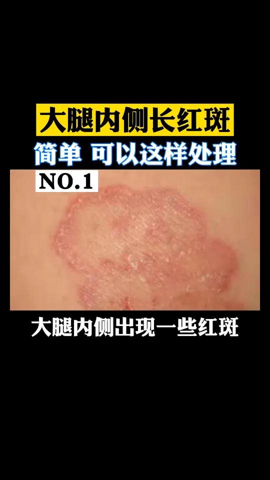 大腿内侧长红斑,非常的痒,股癣可以这样处理