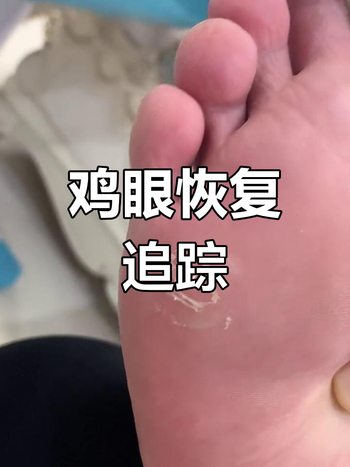 鸡眼膏后十天,皮肤恢复中,但不知是否彻底清除