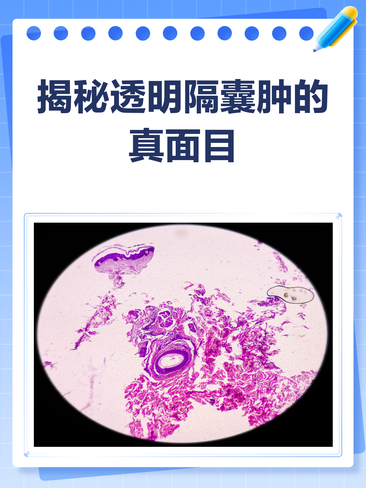 揭秘透明隔囊肿:它到底是什么?