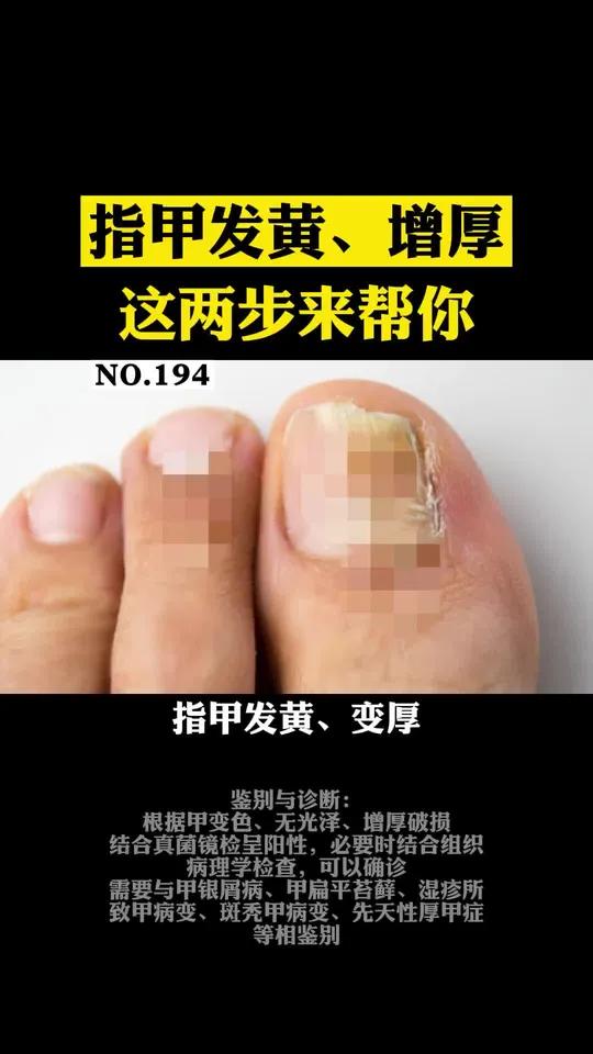 指甲为什么发黄