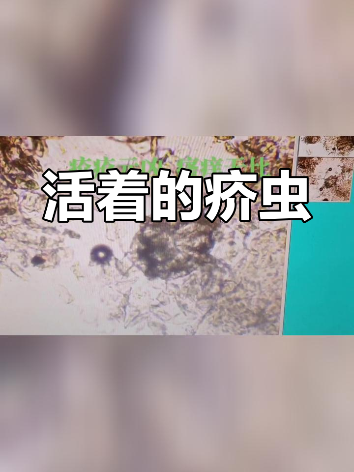 显微镜下的疥虫图片