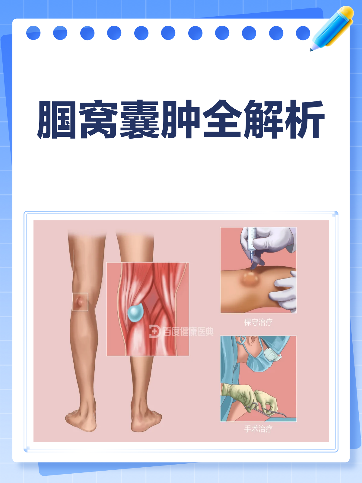 腘窝囊肿知多少?膝盖后的"小包"不简单!