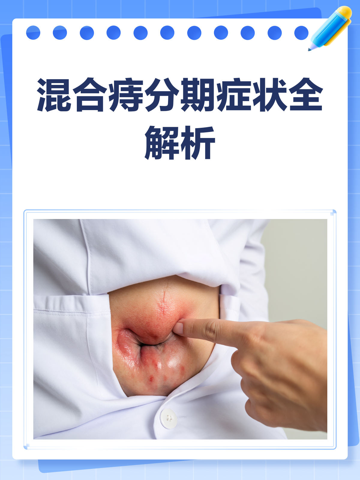 混合痔分期症状全解析,你属于哪一期?