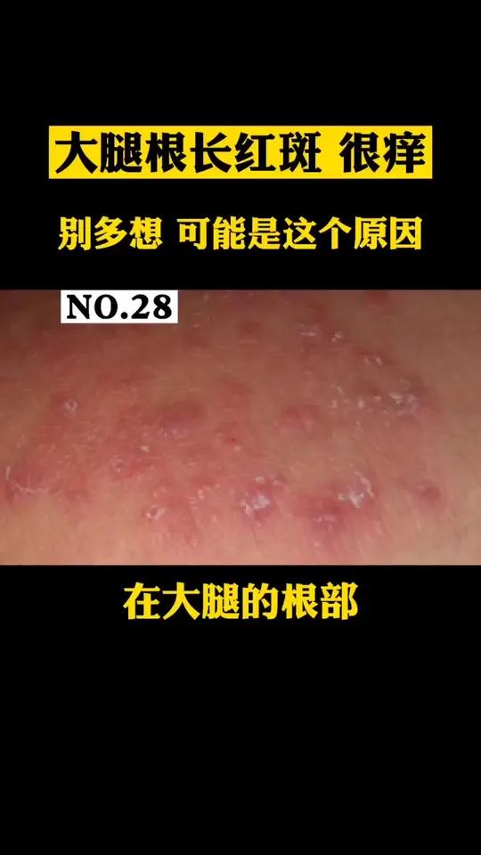 大腿根部出现红斑,非常痒,别再偷偷抓了,这是股癣处理其实很简单