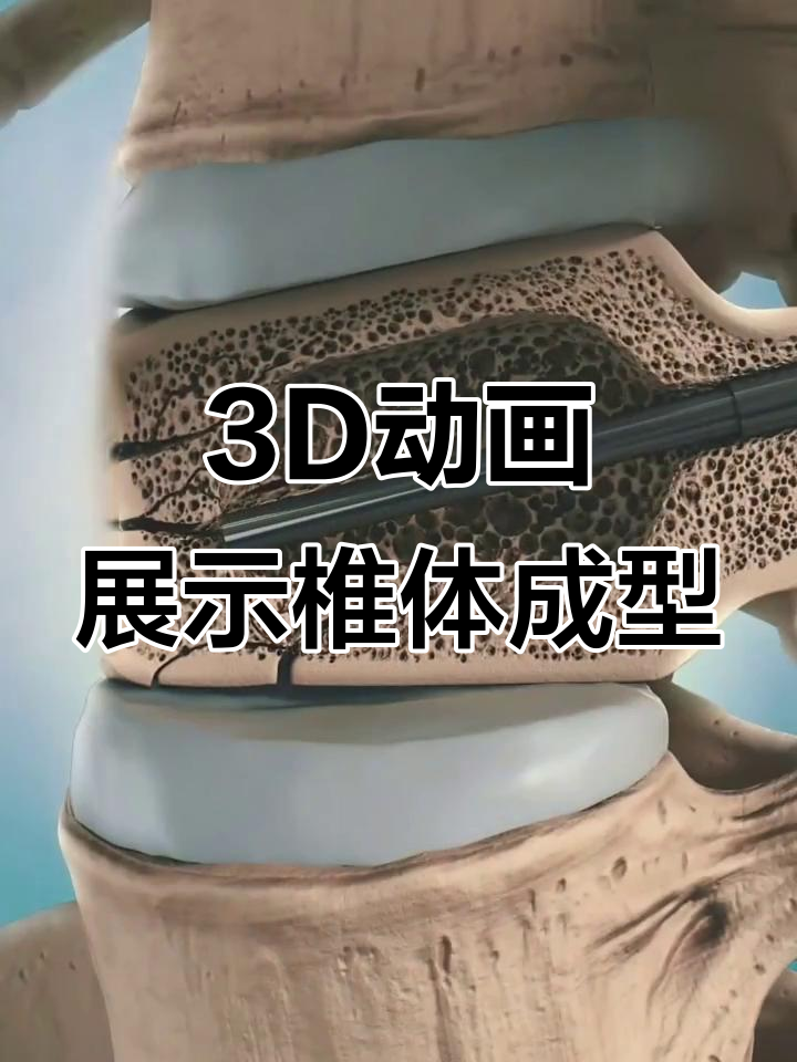 3d动画演示椎体成型术,轻松了解手术过程
