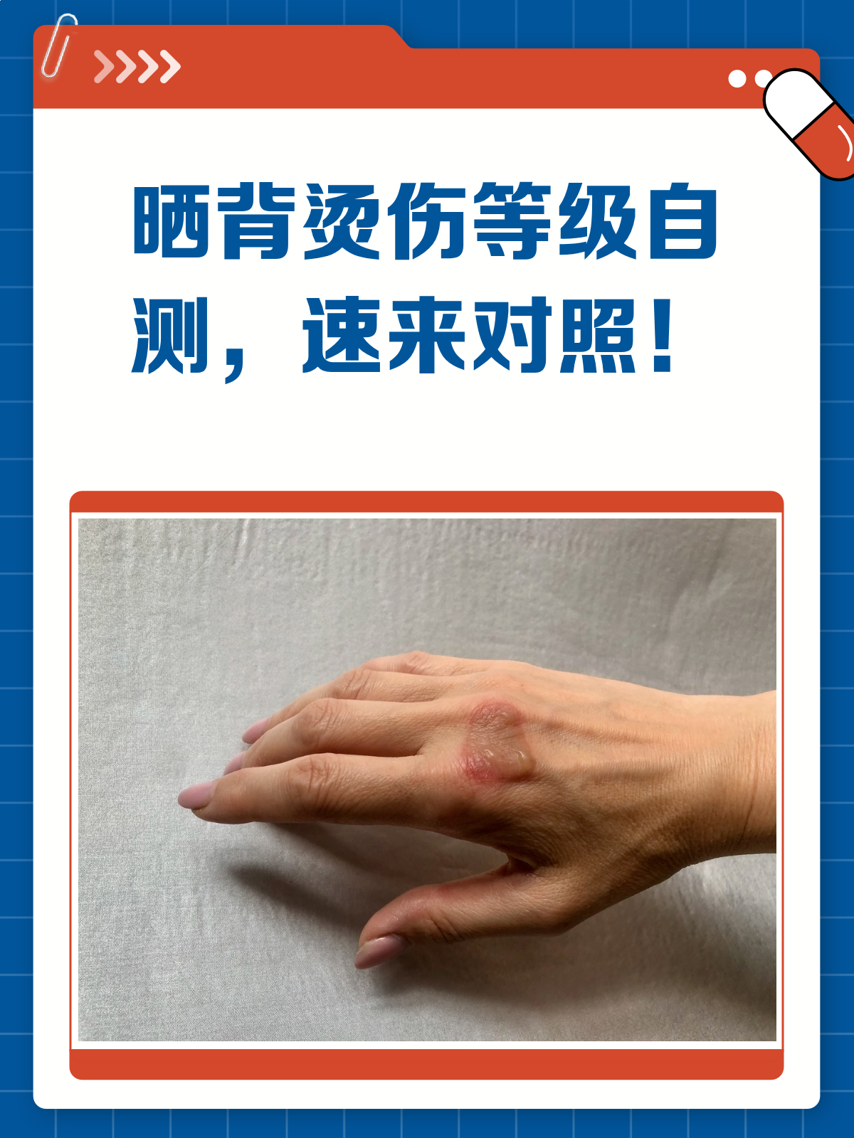 晒背不慎烫伤?快来对照自测表看看等级!