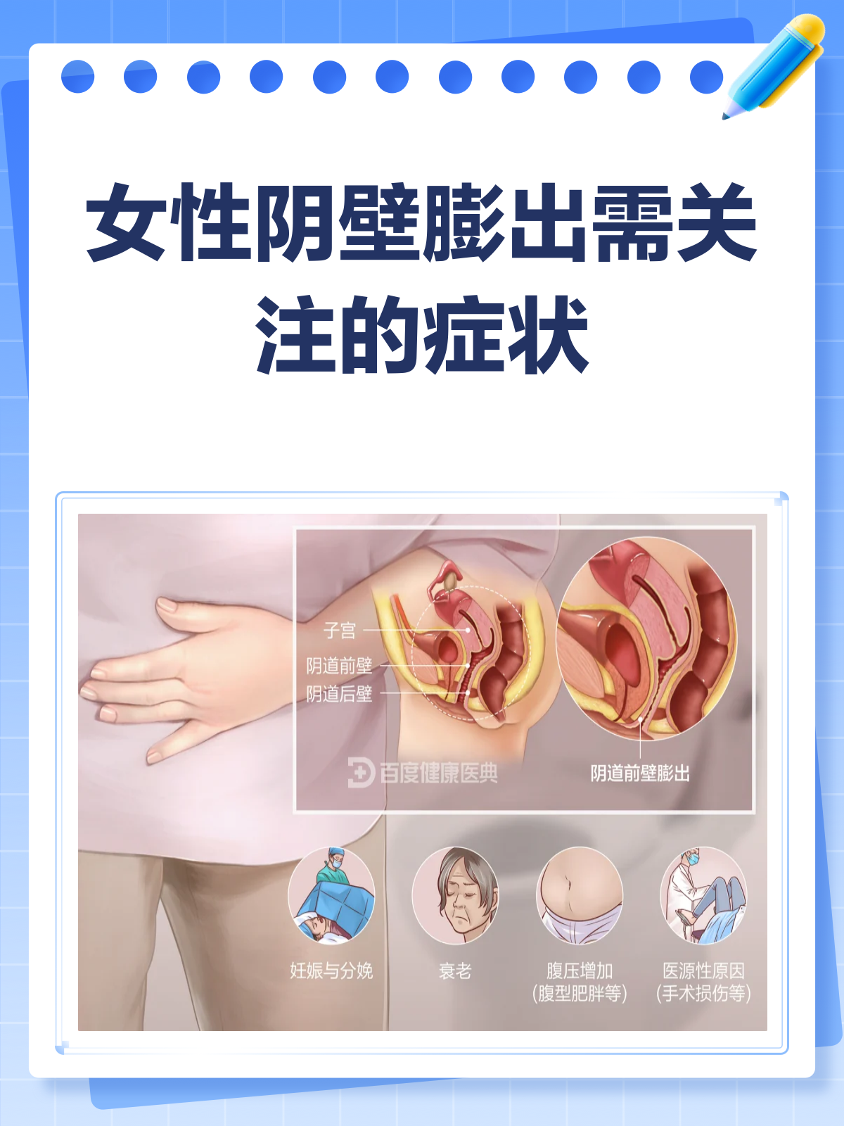 阴壁膨出,你了解多少?一文带你搞清楚!