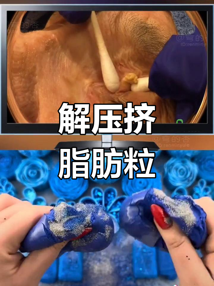 割疳积为什么挤出脂肪粒