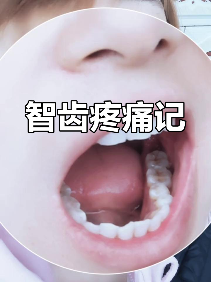 拔智齿花了300块,两个洞疼得要命!