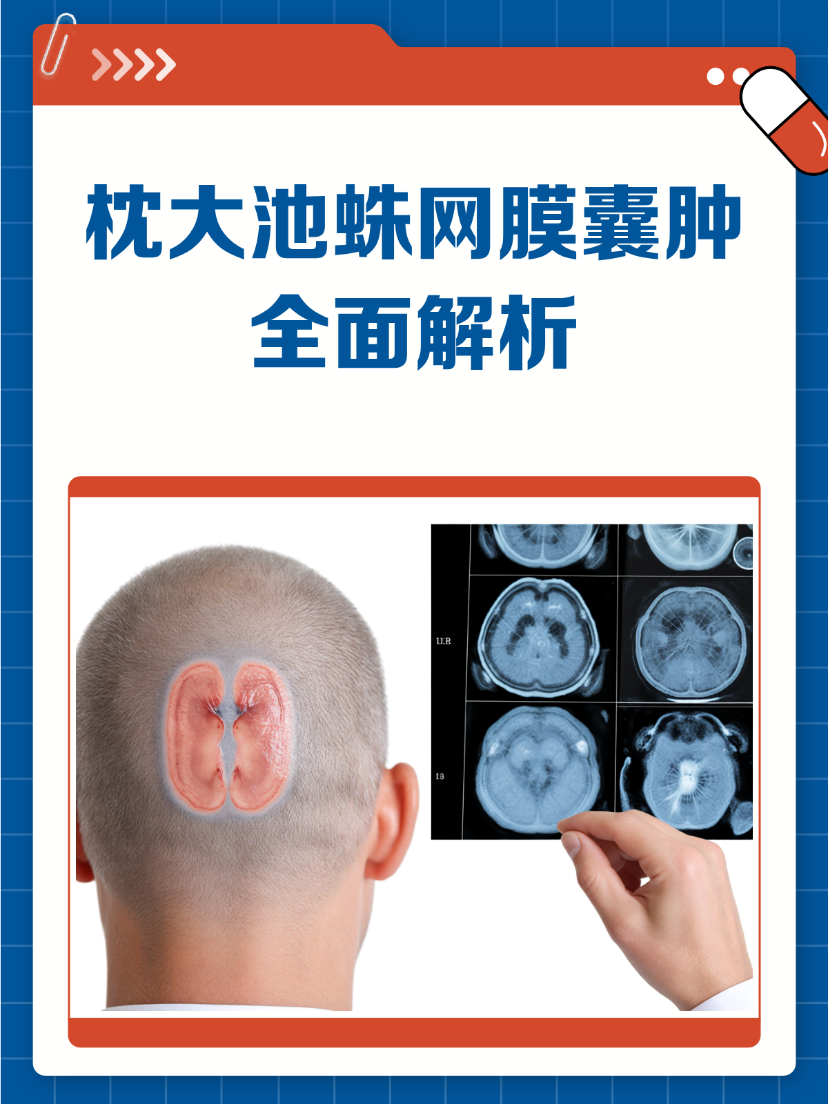 枕大池蛛网膜囊肿?一文读懂它!