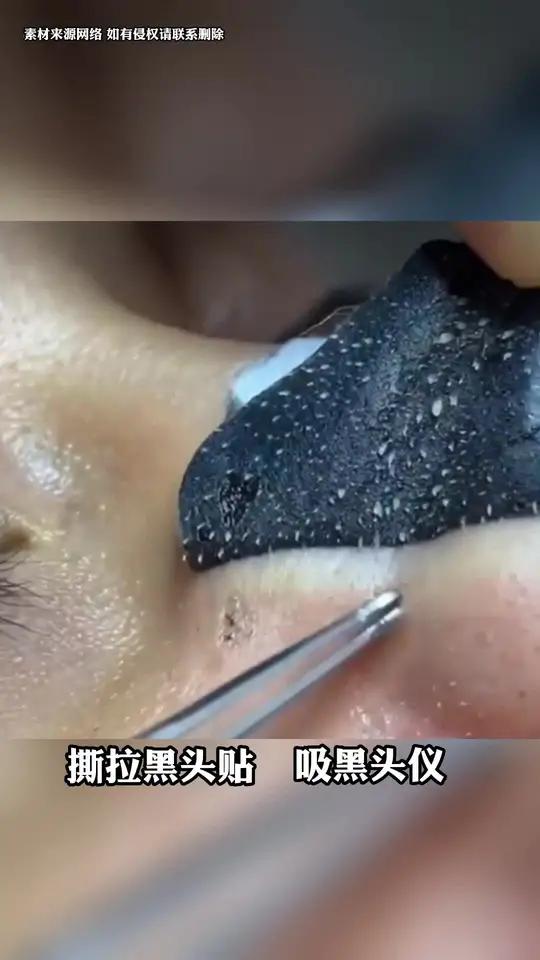 为什么鼻子有黑头就很痒为什么在线