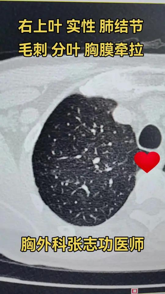 右上肺 10毫米 实性 肺结节毛刺分叶胸膜牵拉,rads 分级4类