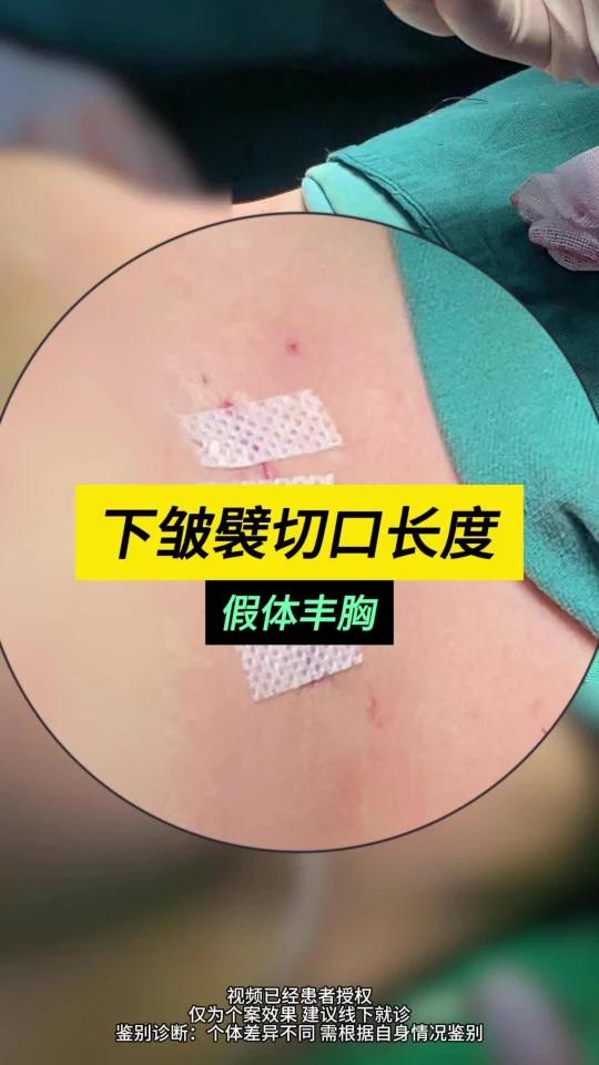 假体隆胸下皱襞切口近距离展示!