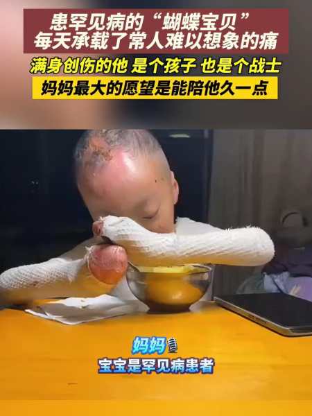 蝴蝶宝宝罕见病图片