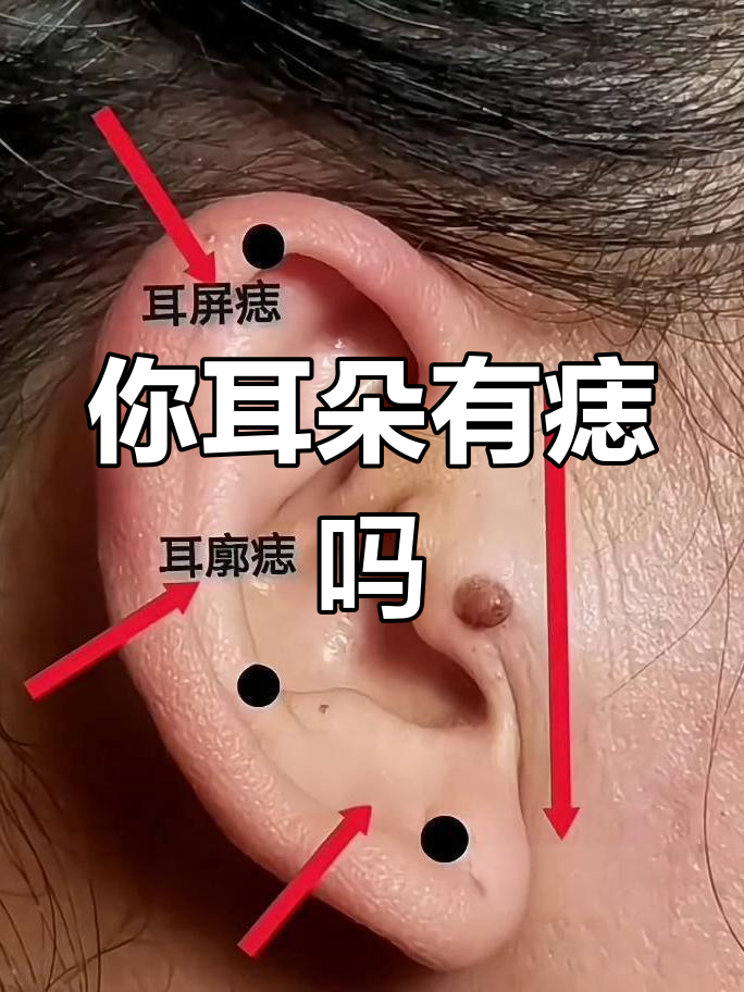耳朵上的痣到底好不好?你的痣长在哪里呢?