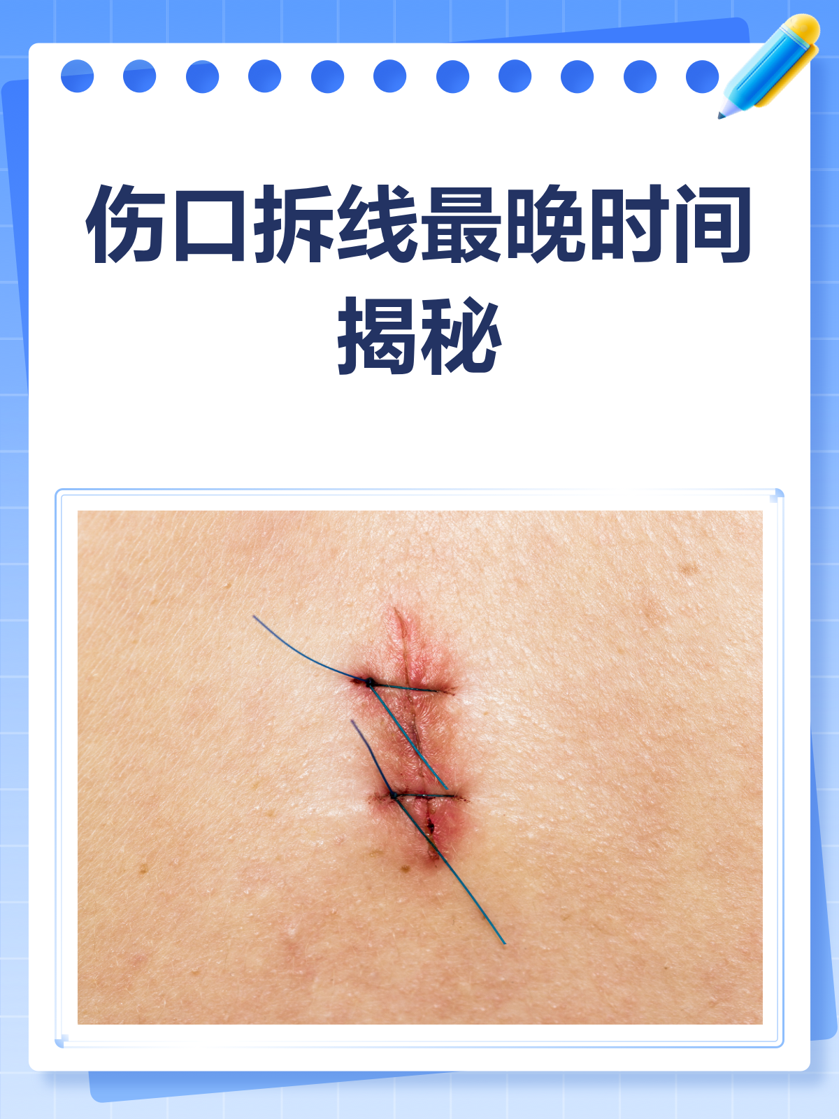 伤口拆线,最晚不能超过几天?