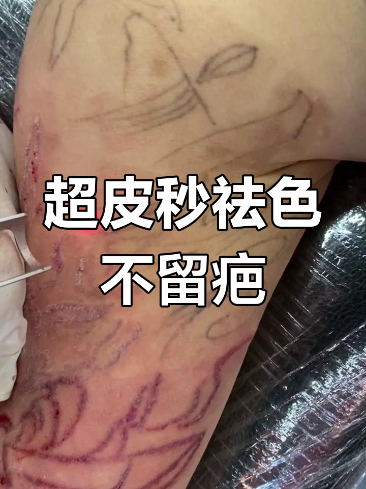 洗纹身20次效果图片