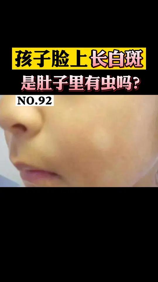 孩子脸上长白斑,是代表肚子里有虫吗?别着急,试试这样处理