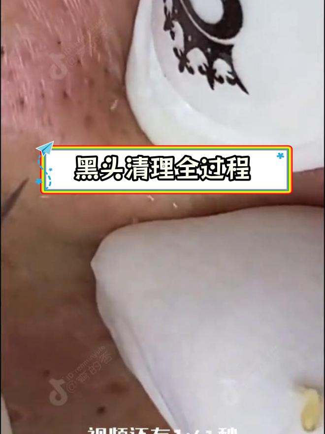 针挑黑头4328图片