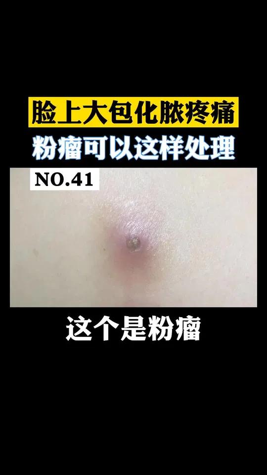 脸上长一个大包,长大还会化脓,粉瘤可以这样处理