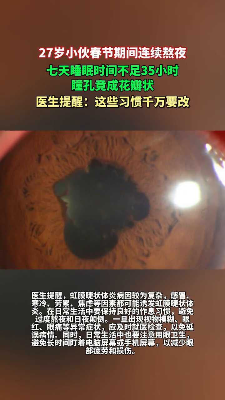 小伙春节期间连续熬夜,七天睡眠时间不足35小时瞳孔竟成花瓣状