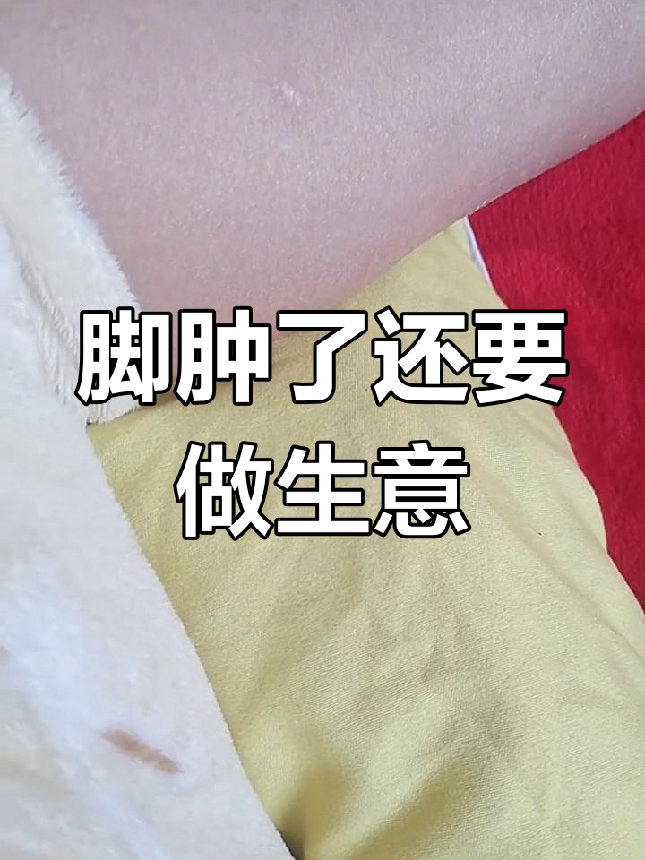 脚肿成这样,生意还得继续做!真是自作孽不可活