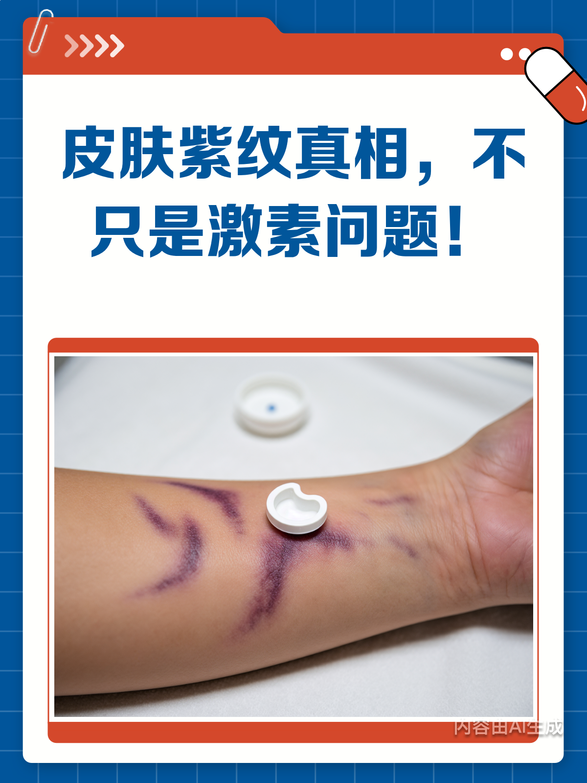 皮肤紫纹是激素"撑裂"的?一文揭秘!