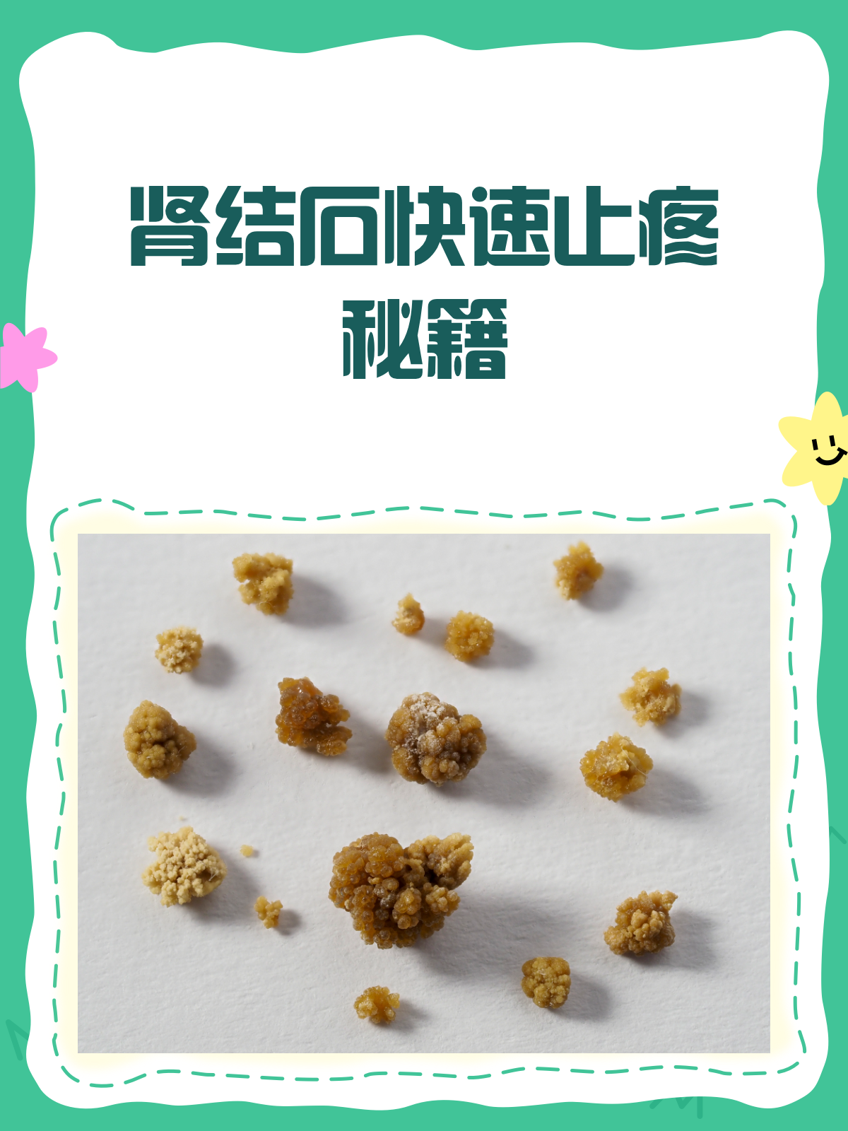 肾结石痛不欲生?快速止疼秘籍来啦!