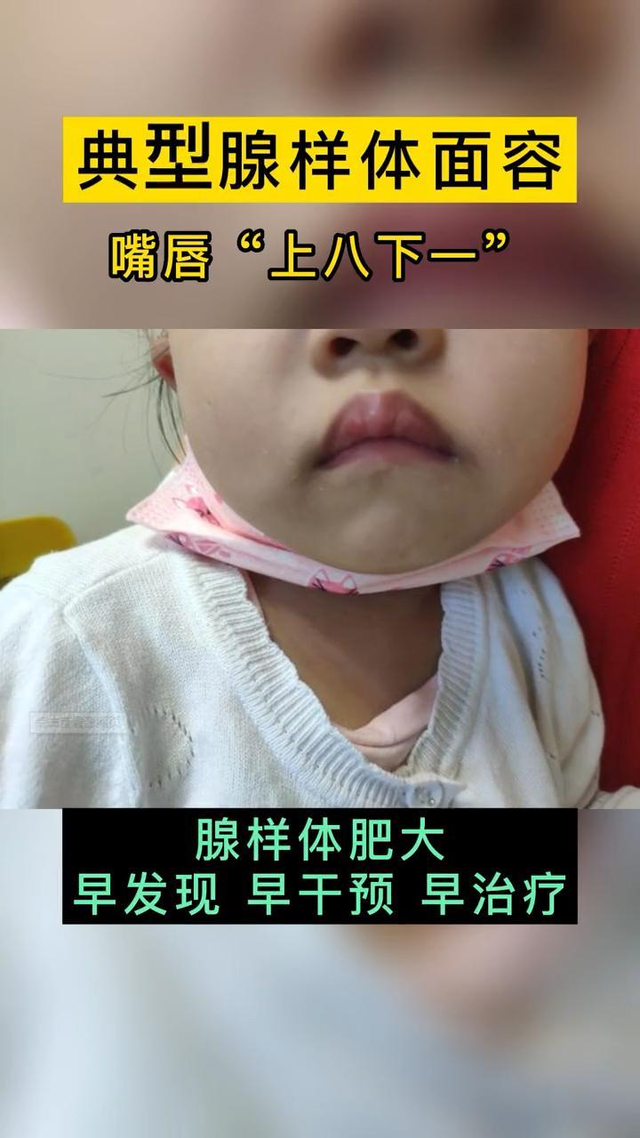 健康科普 医学科普 腺样体面容 涨知识-度小视