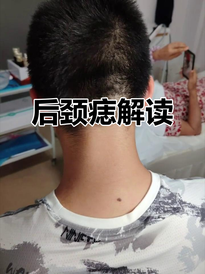 脖子后痣的秘密:凸起与否决定命运