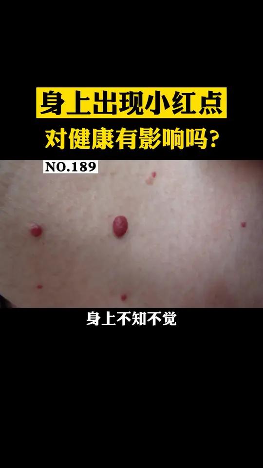 身上突然出现的小红疙瘩,不要担心,这可能是樱桃状血管瘤,对健康没有