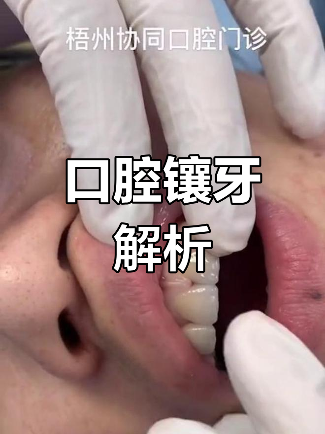 了解口腔镶牙过程