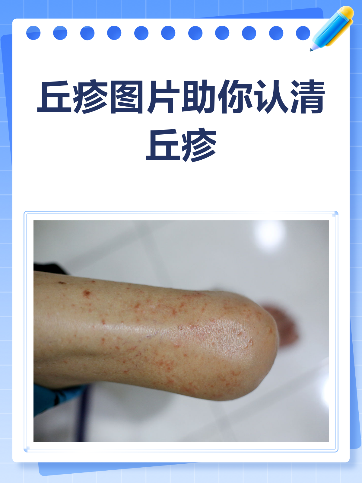 丘疹图片大揭秘!认清症状,不再迷茫!