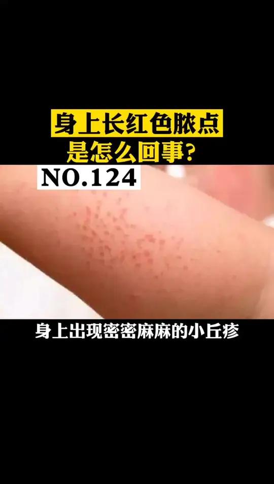 身上长一些密密麻麻的红色小疹子,又刺又痒,这可能是红痱!