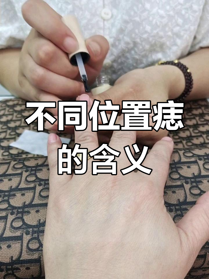 手背痣的寓意与命运