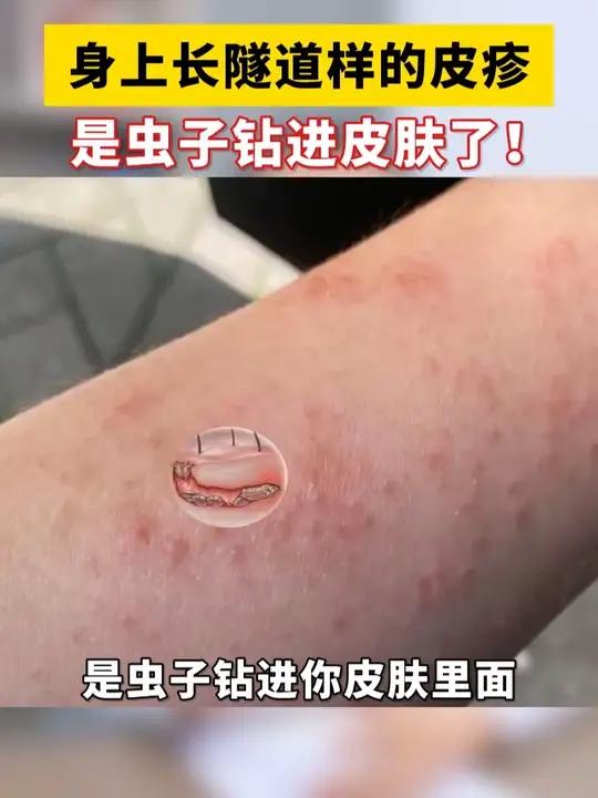 身上长这种隧道样的皮疹,这可能是虫子爬进皮肤了!