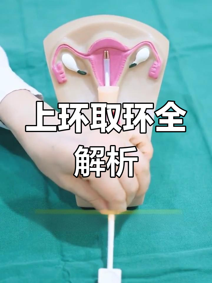 女性上环取环全过程,轻松了解操作步骤