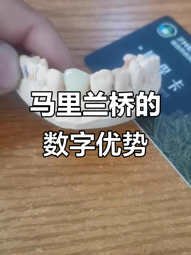 数字化义齿加工:马里兰桥的优势与挑战