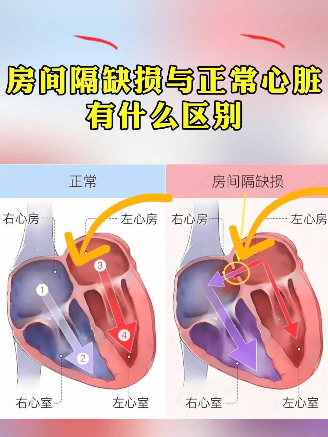 房间隔缺损与正常心脏有什么区别 抖出健康知识宝藏 医疗科普 室间隔